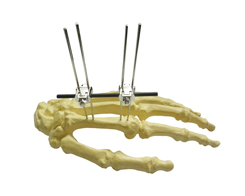 Modular-external-fixation-system-supplies-cameroon Modular-external-fixation-system-supplies-cameroon